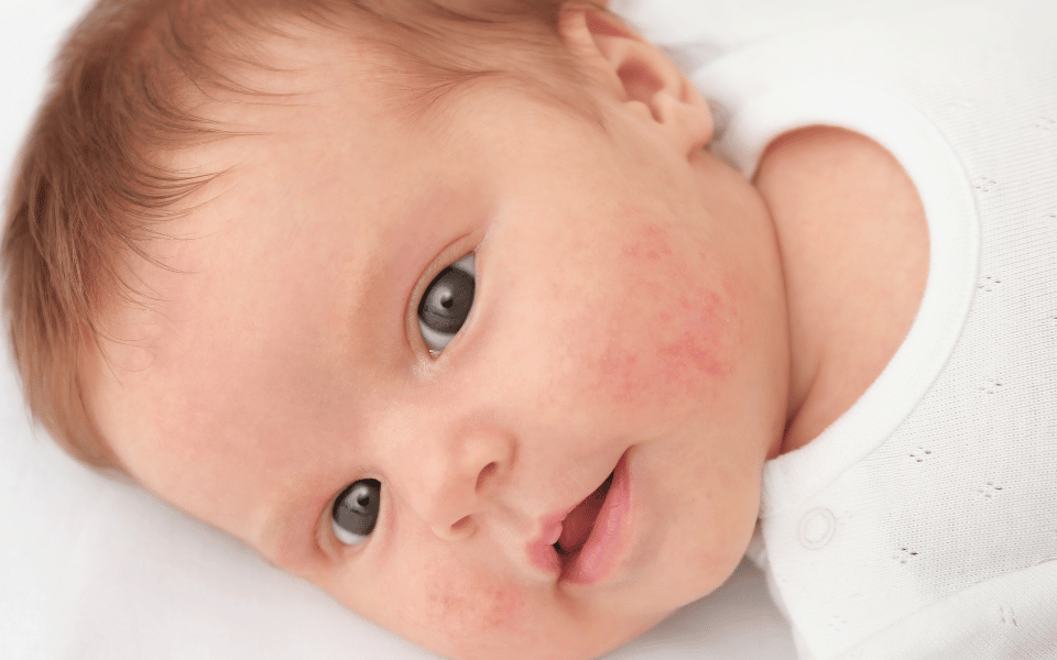 Imagine - reactiile-adverse-ale-bebelusilor-la-anumite-alimente-intre-precautie-si-interventie-medicala